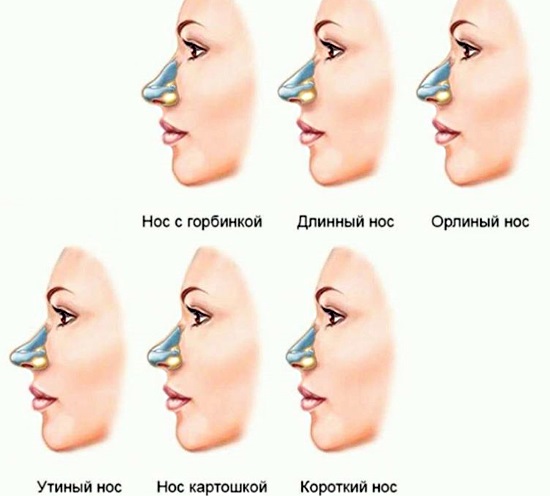 How to fix a woman's nose with potatoes. Rhinoplasty, photo before and after surgery, price