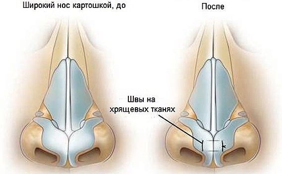 How to fix a woman's nose with potatoes. Rhinoplasty, photo before and after surgery, price