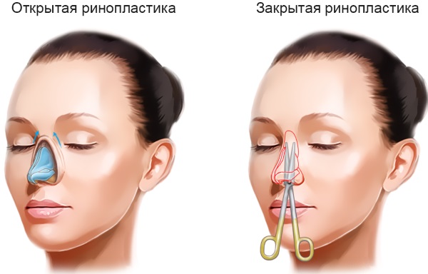 How to fix a woman's nose with potatoes. Rhinoplasty, photo before and after surgery, price