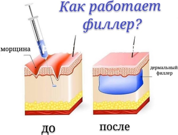 Correction of the nasolacrimal groove with fillers. Indications, before and after photos, price of the procedure, possible complications