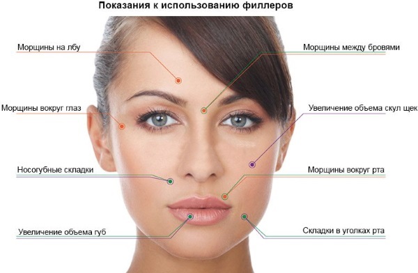 Correction of the nasolacrimal groove with fillers. Indications, before and after photos, price of the procedure, possible complications