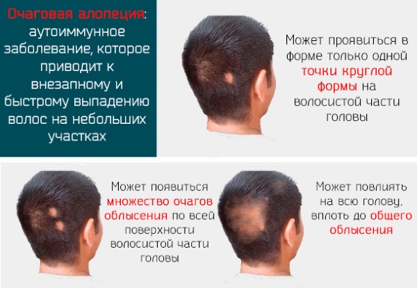 Plasmolifting of the head for hair. Before and after photos, contraindications, reviews