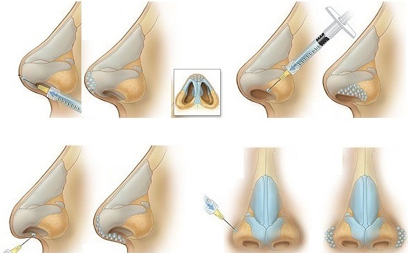 Rinoplastica non chirurgica della punta del naso con filler, farmaci. Foto prima e dopo, prezzo