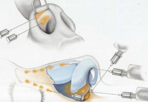 Rinoplastica non chirurgica della punta del naso con filler, farmaci. Foto prima e dopo, prezzo