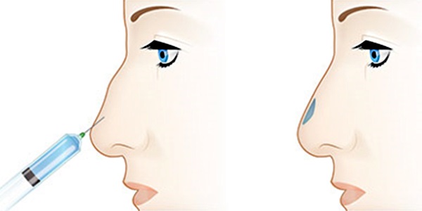 Non-surgical rhinoplasty of the tip of the nose with filler, drugs. Before and after photos, price