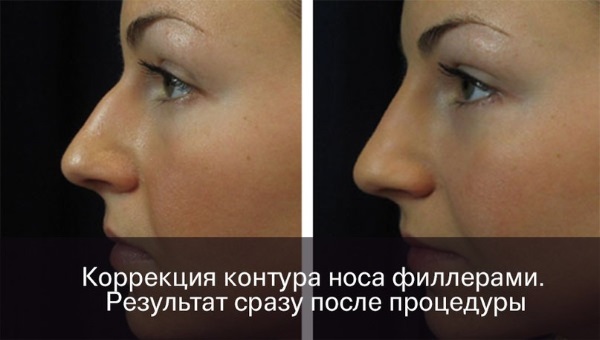 Non-surgical rhinoplasty of the tip of the nose with filler, drugs. Before and after photos, price