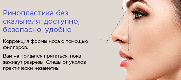 Non-surgical rhinoplasty of the tip of the nose with filler, drugs. Before and after photos, price