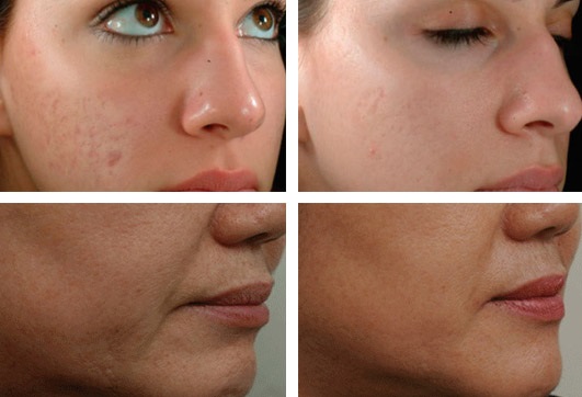 Fractional facial mesotherapy: indications, results, side effects, consequences. Reviews