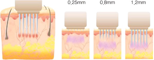 Fractional facial mesotherapy: indications, results, side effects, consequences. Reviews