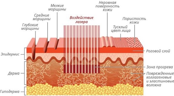 Fractional photothermolysis.What is this procedure, the effects, how is it done, before and after photos, reviews, price