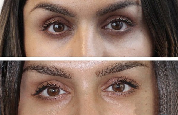 How to get rid of dark circles under the eyes at home, cosmetology