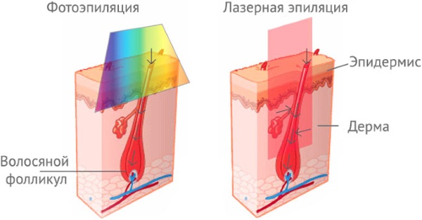 Deep bikini zone laser hair removal. Contraindications, photo, price of the procedure