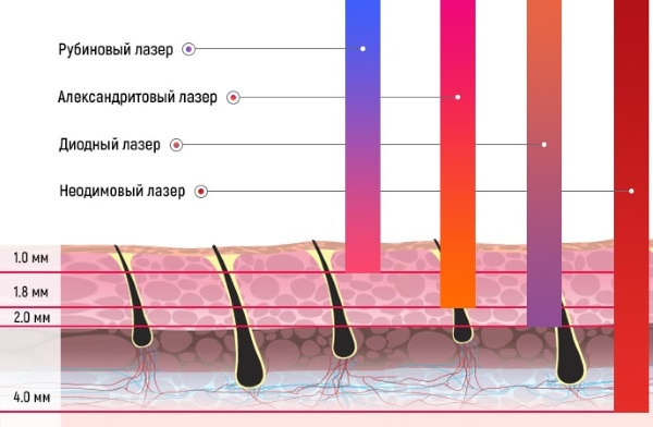 Deep bikini zone laser hair removal. Contraindications, photo, price of the procedure