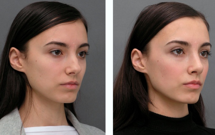 Non-surgical rhinoplasty of the nose. Photo, how it is done, how to choose a clinic, a doctor. Reviews