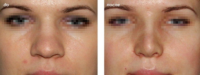 Non-surgical rhinoplasty of the nose. Photo, how it is done, how to choose a clinic, a doctor. Reviews