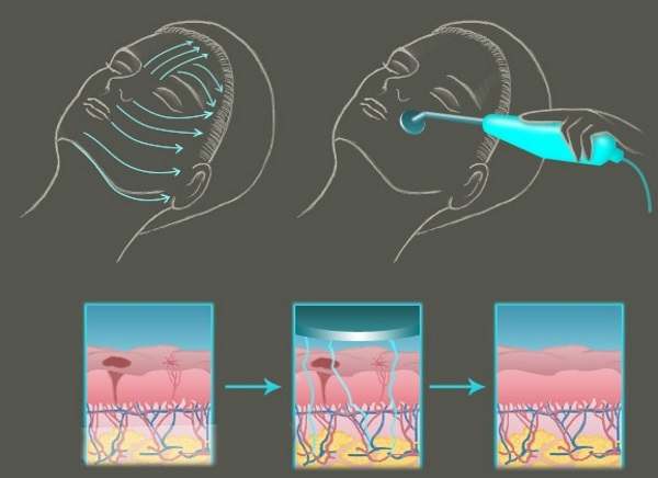 Darsonval for the face.How to use it yourself correctly. Videos, reviews