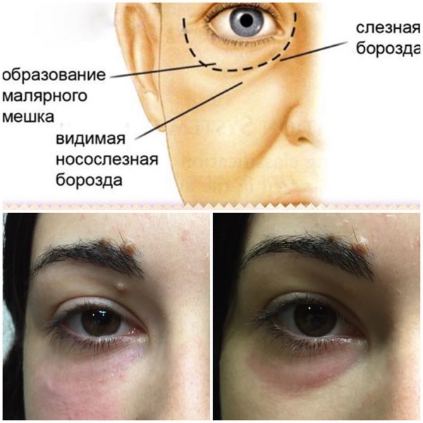 Tyndall effect in cosmetology under the eyes, on the skin of the lips. When observed how to remove