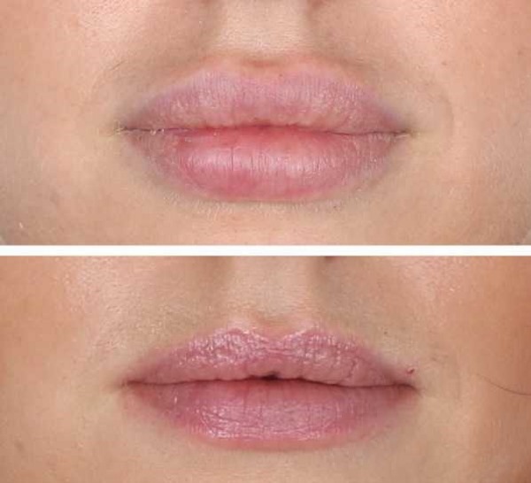 Tyndall effect in cosmetology under the eyes, on the skin of the lips. When observed how to remove