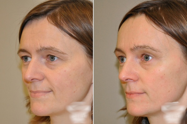 Endoscopic forehead and eyebrow lifting. Photos before and after, how it is done, consequences, reviews