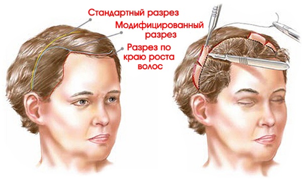 Endoscopic forehead and eyebrow lifting. Photos before and after, how it is done, consequences, reviews