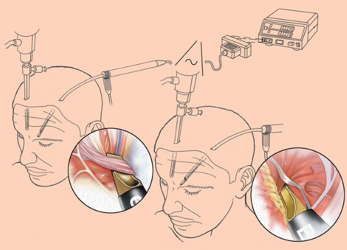 Endoscopic forehead and eyebrow lifting. Photos before and after, how it is done, consequences, reviews