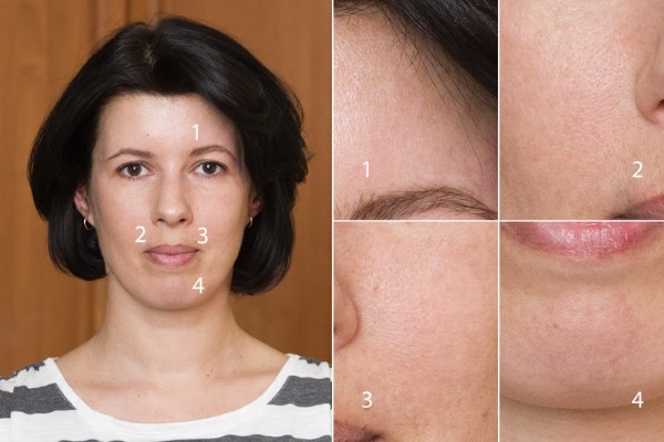 Fraxel laser therapy for facial skin. Indications, before and after photos, reviews