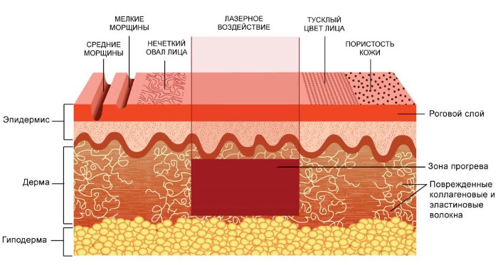 Fraxel laser therapy for facial skin. Indications, before and after photos, reviews