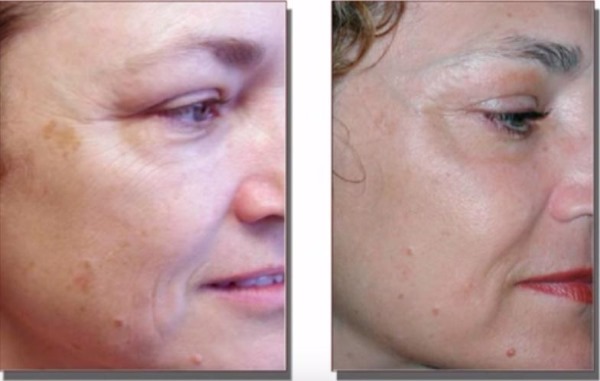 Fraxel laser therapy for facial skin. Indications, before and after photos, reviews