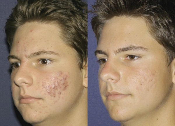 Fraxel laser therapy for facial skin. Indications, before and after photos, reviews