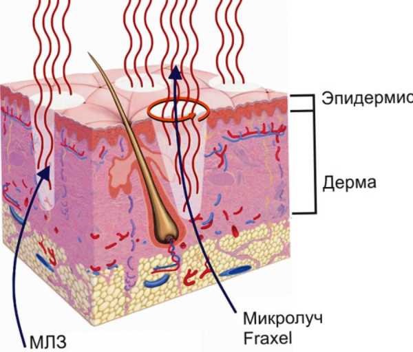 Fraxel laser therapy for facial skin. Indications, before and after photos, reviews