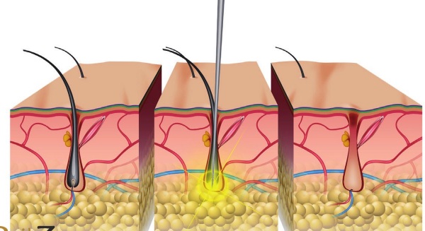 Haarentfernung im tiefen Bikinibereich. Sugaring, Laser-Haarentfernung, Wachsen, Photoepilation, Elektrolyse, Bioepilation