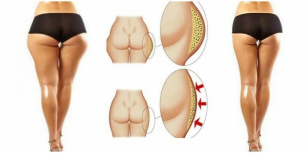 How to remove breeches on hips for a girl. Exercises, training complex in the gym