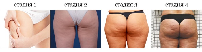 How to remove cellulite on the legs and bottom. Exercises for the week, training program for girls