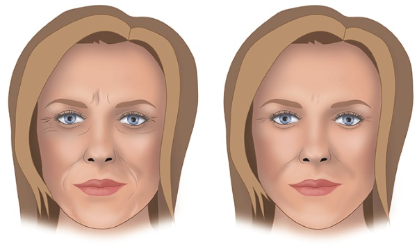 Contouring of the nose, cheekbones, lips, chin, nasolabial folds. How is it done, price, reviews