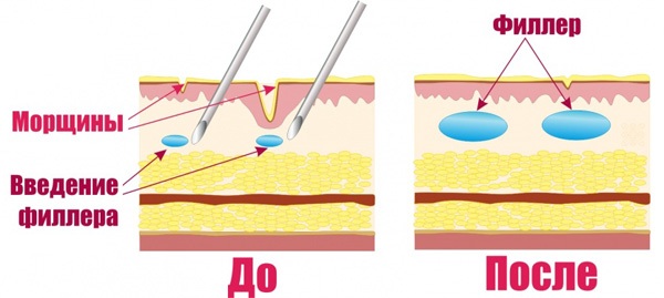 Contouring of the nose, cheekbones, lips, chin, nasolabial folds. How is it done, price, reviews