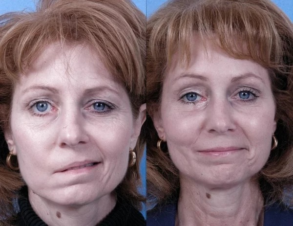 Contouring of the nose, cheekbones, lips, chin, nasolabial folds. How is it done, price, reviews