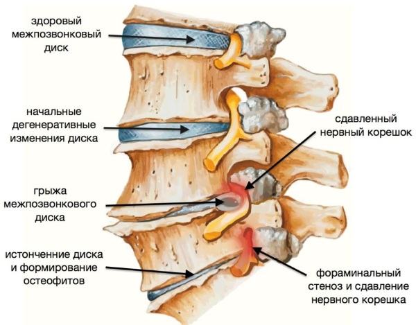 Neck and shoulder and back massager. Which is better: roller, wooden, belt, electric