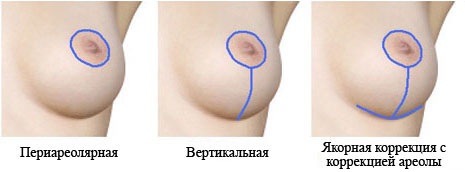 Breast reduction surgery mammoplasty. How much does a facelift cost, types, how to do it for free