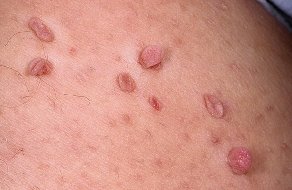 Papillomas on the body in women. Causes and treatment, how to get rid of folk remedies