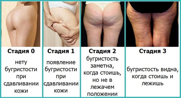 How to make a massage for slimming the abdomen and sides: vacuum, Chinese, visceral anti-cellulite, lymphatic drainage