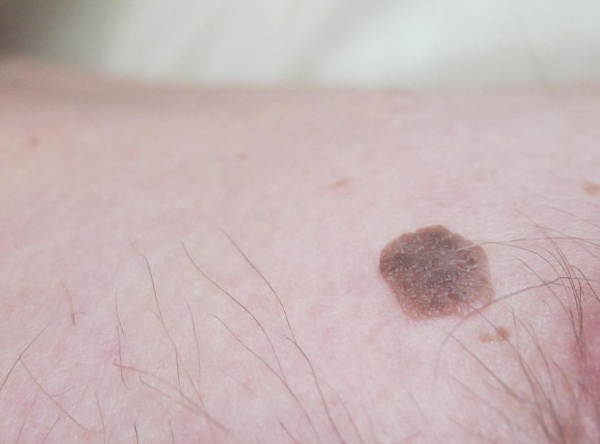 Laser removal of neoplasms on the skin, growths, papillomas. How is the procedure, price, reviews