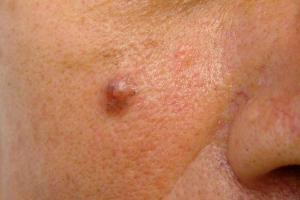 Laser removal of neoplasms on the skin, growths, papillomas. How is the procedure, price, reviews