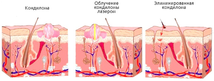 Laser removal of neoplasms on the skin, growths, papillomas. How is the procedure, price, reviews