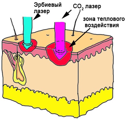 Laser removal of neoplasms on the skin, growths, papillomas. How is the procedure, price, reviews