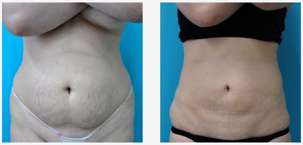 Non-surgical liposuction of the abdomen. Photo before and after laser, ultrasound, reviews, price