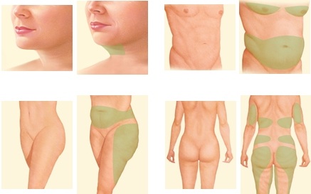 Non-surgical liposuction of the abdomen. Photo before and after laser, ultrasound, reviews, price