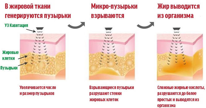 Non-surgical liposuction of the abdomen. Photo before and after laser, ultrasound, reviews, price