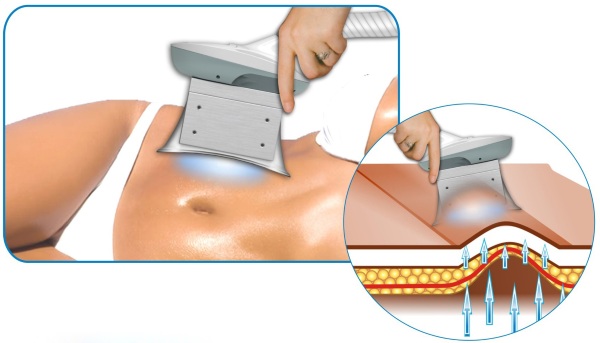 Non-surgical liposuction of the abdomen. Photo before and after laser, ultrasound, reviews, price