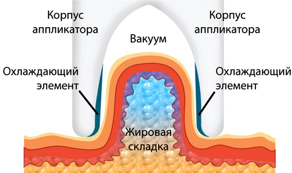 Non-surgical liposuction of the abdomen. Photo before and after laser, ultrasound, reviews, price