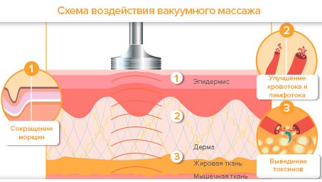 Non-surgical liposuction of the abdomen. Photo before and after laser, ultrasound, reviews, price